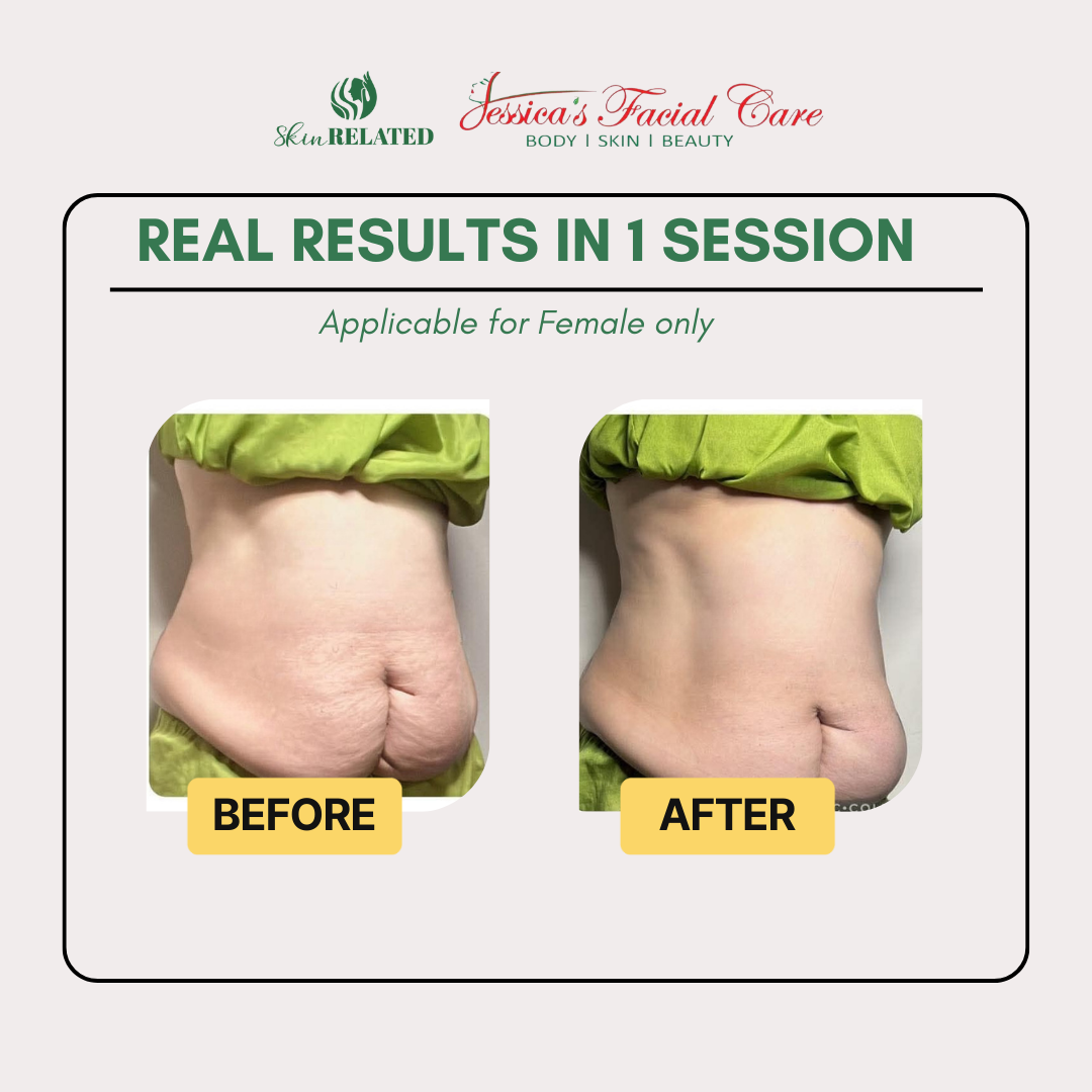🔥 The Ultimate Slim & Sculpt Package (Abdomen + Back) 🔥