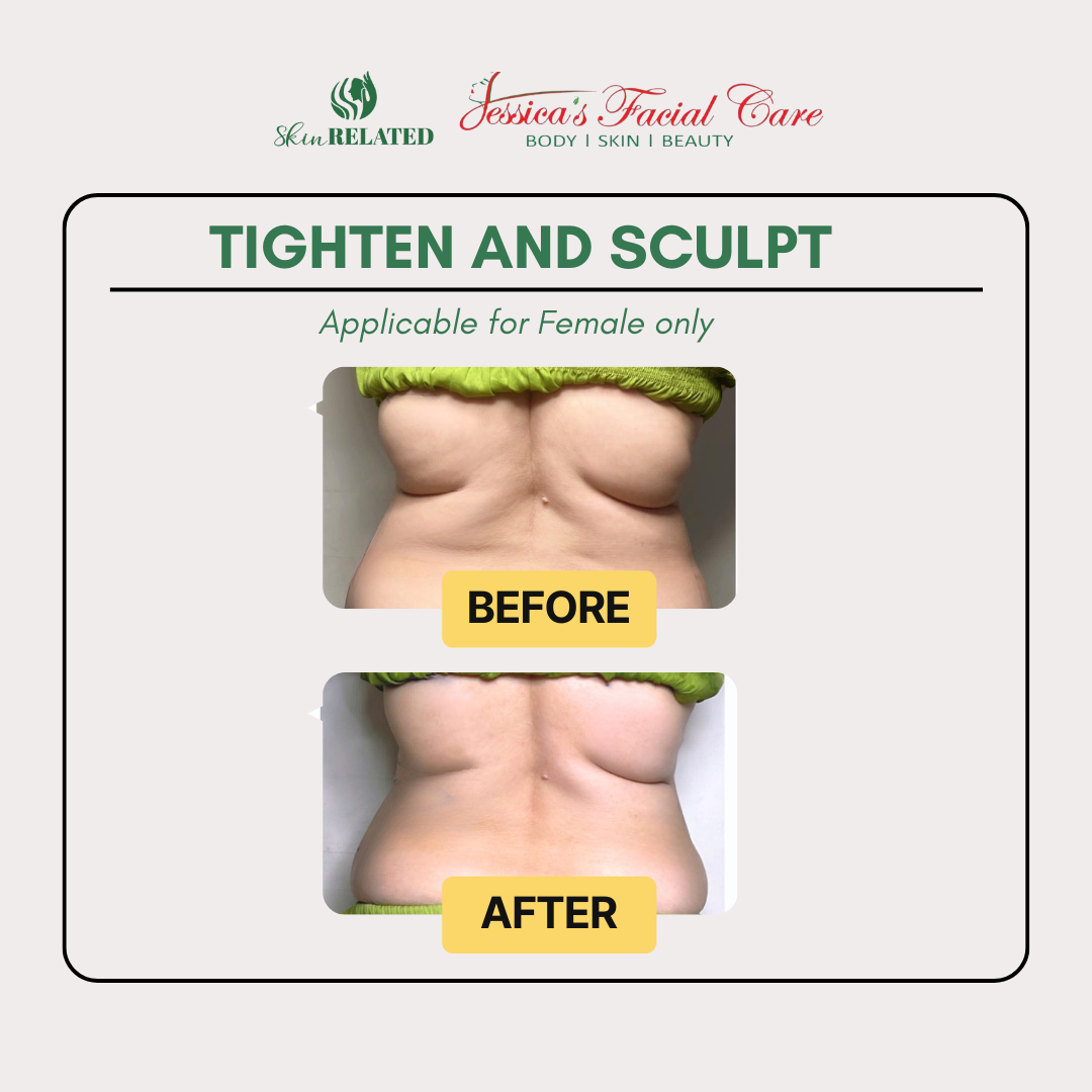 Back Sculpting with UltraSlim MesoLipo